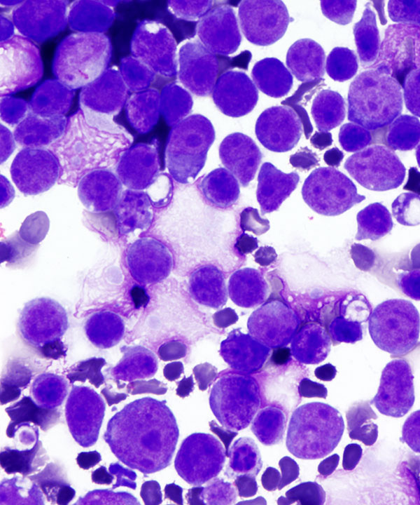 05 : Fluids Prim Eff Lymphoma