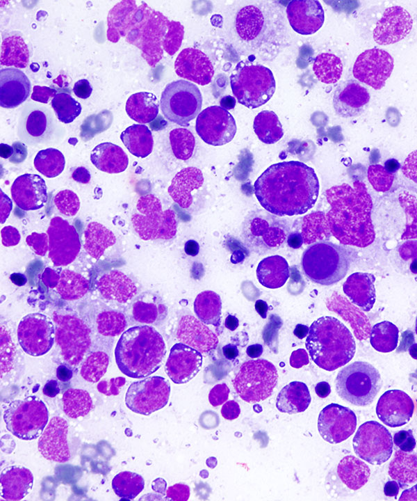 06 : Fluids Prim Eff Lymphoma