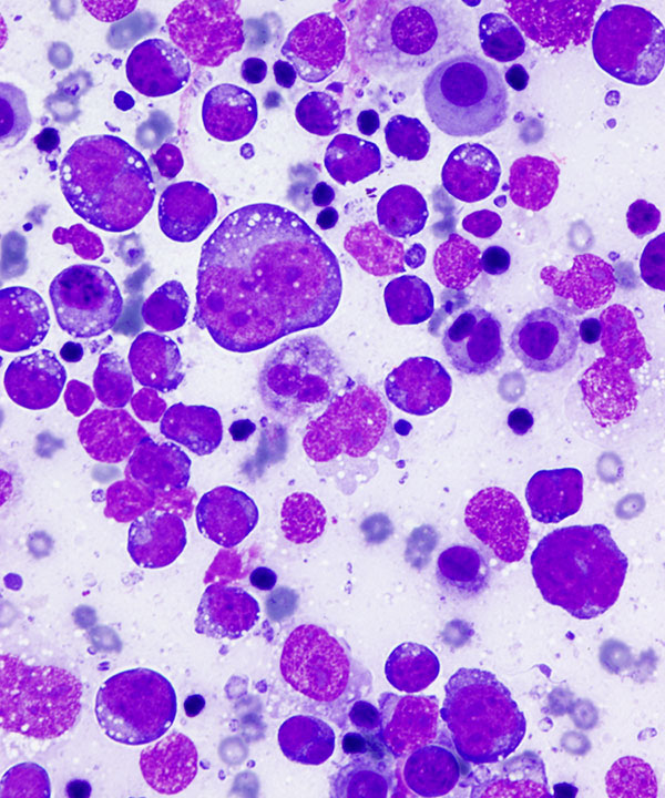 07 : Fluids Prim Eff Lymphoma