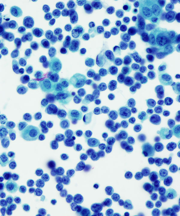 08 : Fluids Prim Eff Lymphoma