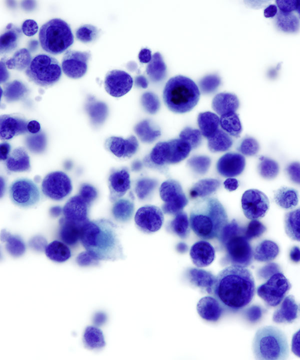 10 : Fluids Prim Eff Lymphoma