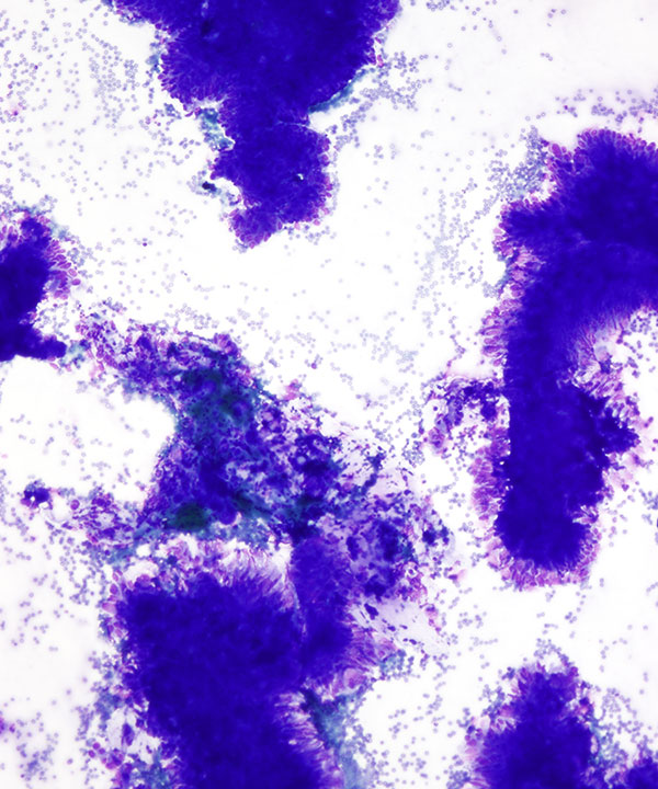 image showing 'Ampullary Adenocarcinoma'