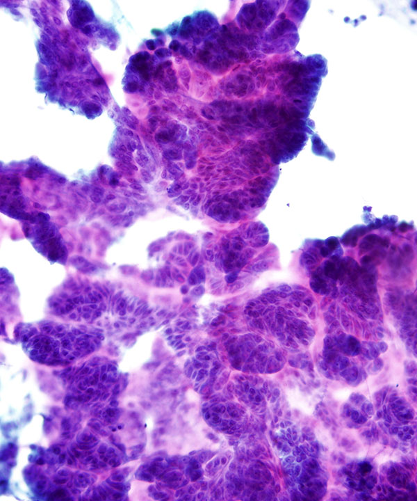 04 : Gastrointestinal Tract Ampullary Adenocarcinoma