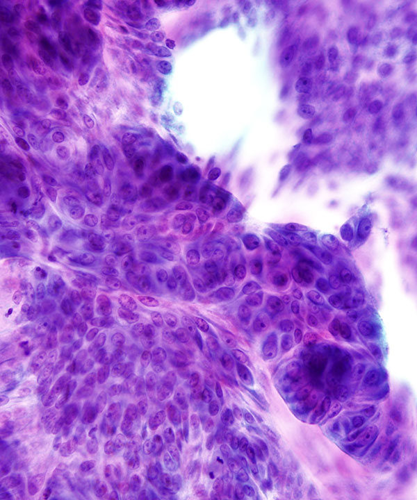 05 : Gastrointestinal Tract Ampullary Adenocarcinoma