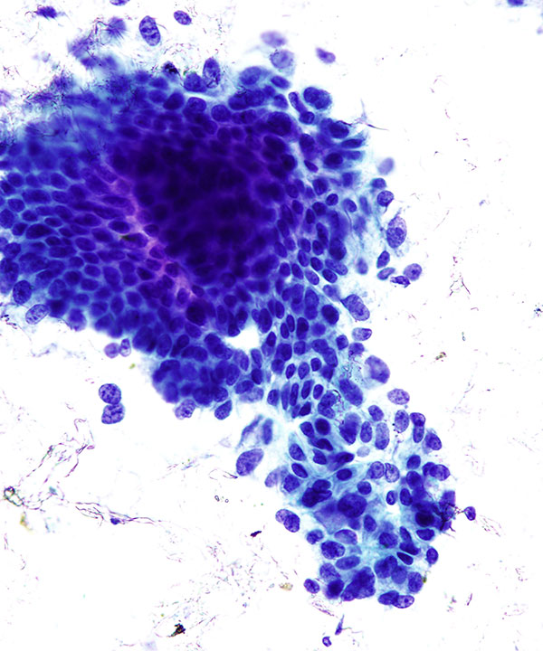 1 :  Bile Duct Adenocarcinoma