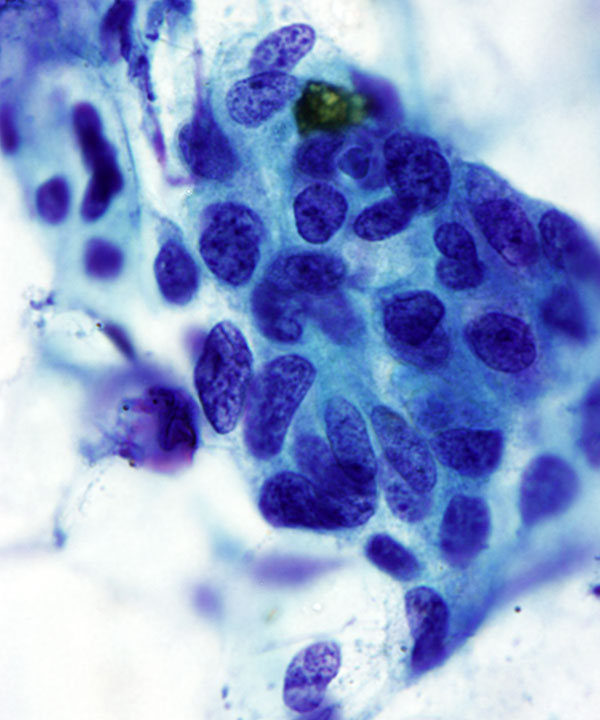 image showing 'Bile Duct Adenocarcinoma'