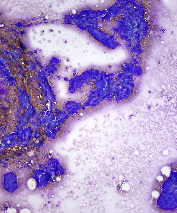 image showing 'Colorectal Adenocarcinoma'