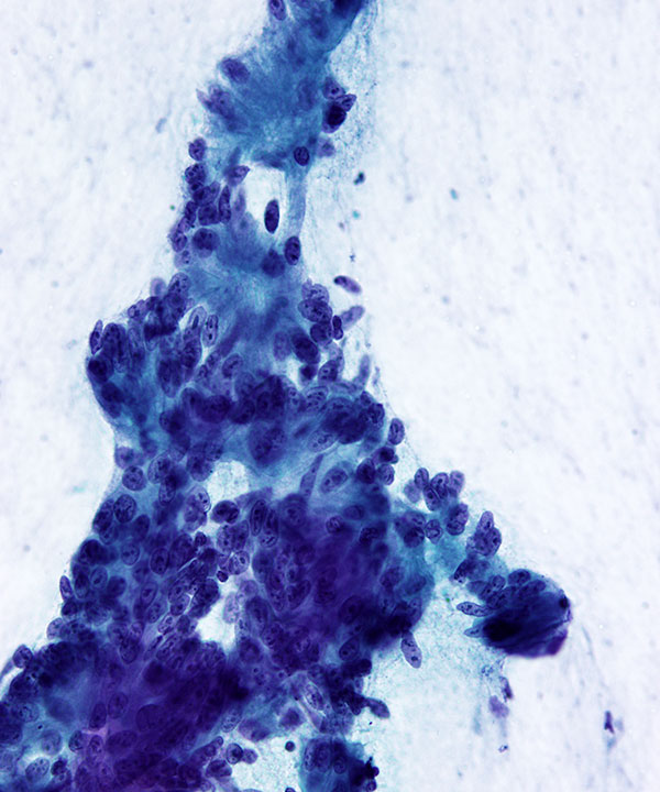03 : GI Tract Colorectal Adenocarcinoma