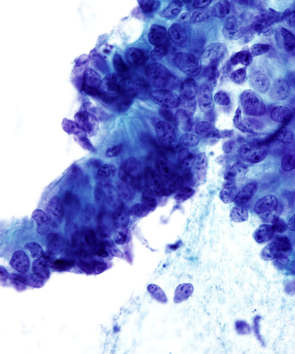 04 : GI Tract Colorectal Adenocarcinoma