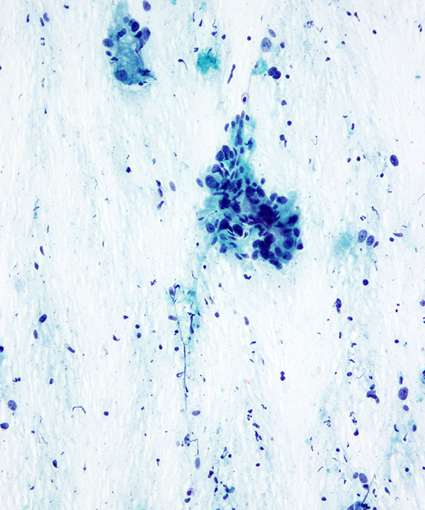 03 : GI Esophageal Adenocarcinoma