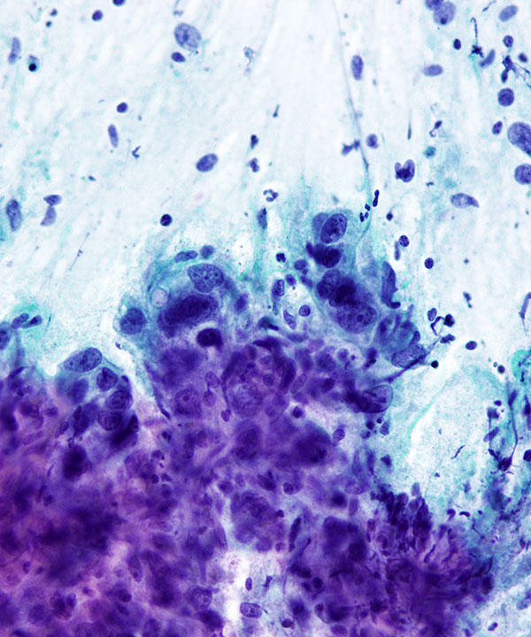 04 : GI Esophageal Adenocarcinoma