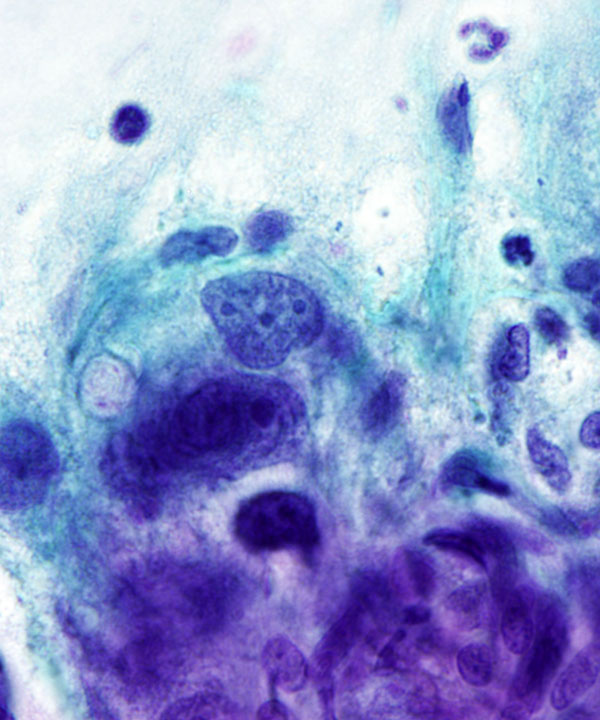 05 : GI Esophageal Adenocarcinoma