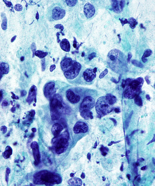 06 : GI Esophageal Adenocarcinoma