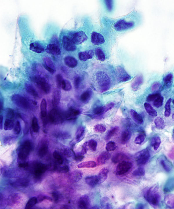 07 : GI Esophageal Squamous cell Carcinoma