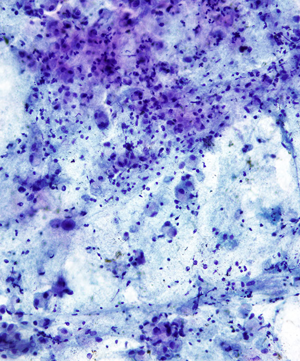 image showing 'Gastric Adenocarcinoma'