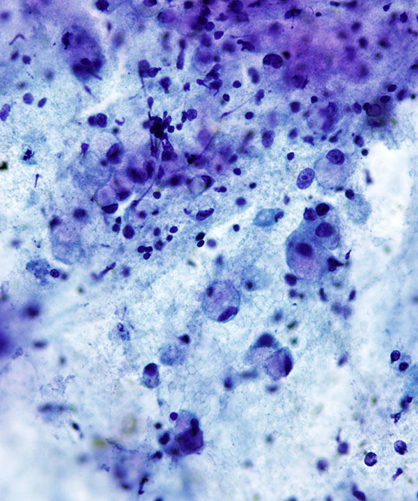 02 : Gastrointestinal Tract Gastric Adenocarcinoma