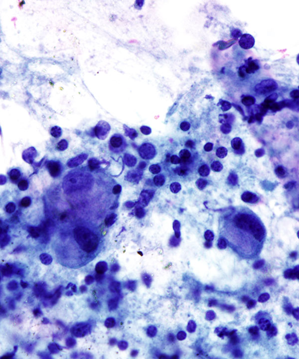 03 : Gastrointestinal Tract Gastric Adenocarcinoma