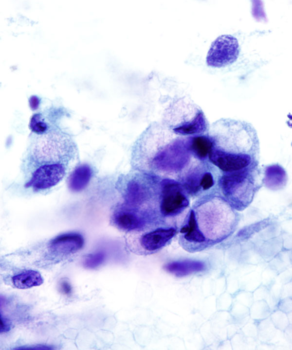 05 : Gastrointestinal Tract Gastric Adenocarcinoma