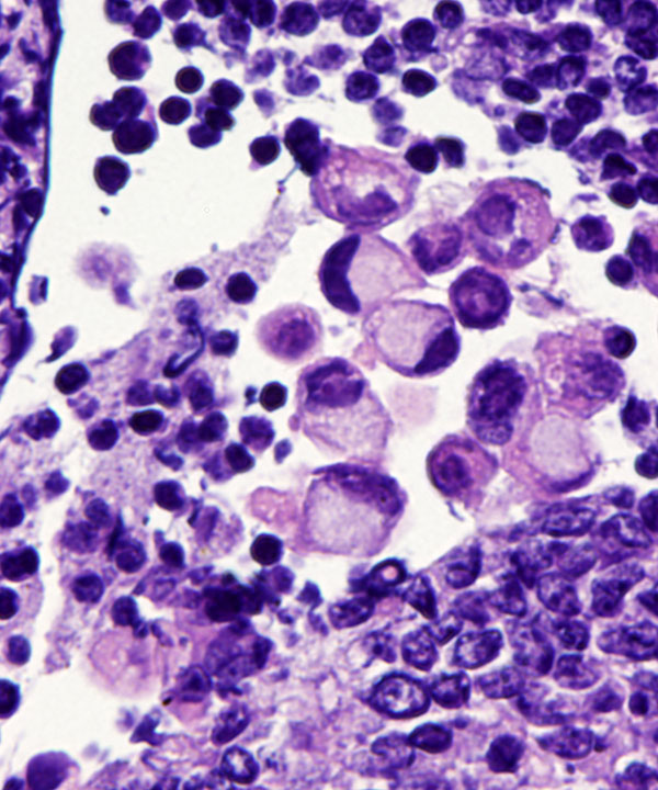 06 : Gastrointestinal Tract Gastric Adenocarcinoma