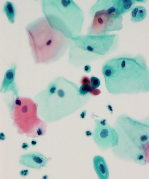 image showing 'Atypical Squamous Cell (ASC-H)'