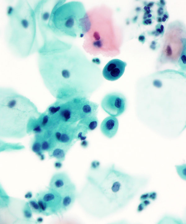 02 : Gynecologic Atypical Squamous Cell (ASC-H)
