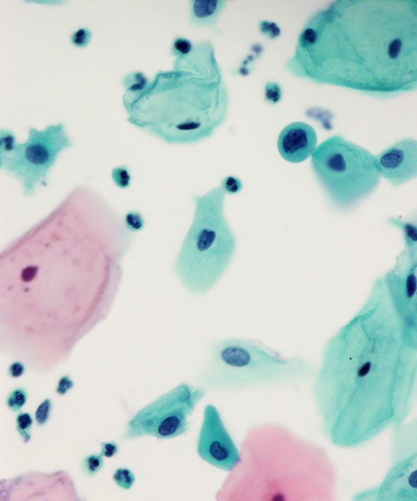 03 : Gynecologic Atypical Squamous Cell (ASC-H)