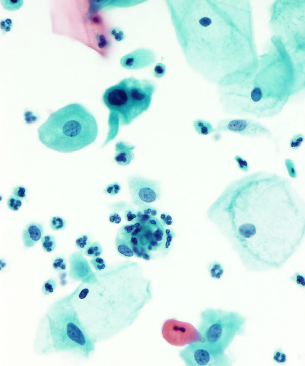 04 : Gynecologic Atypical Squamous Cell (ASC-H)