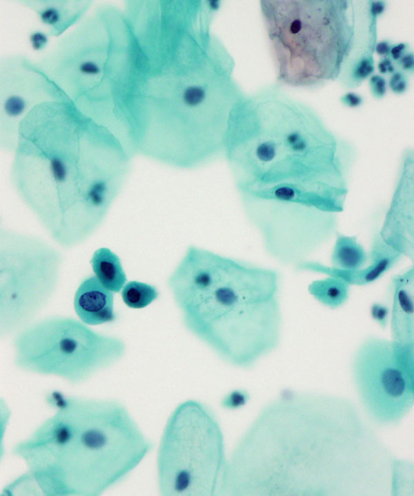 05 : Gynecologic Atypical Squamous Cell (ASC-H)