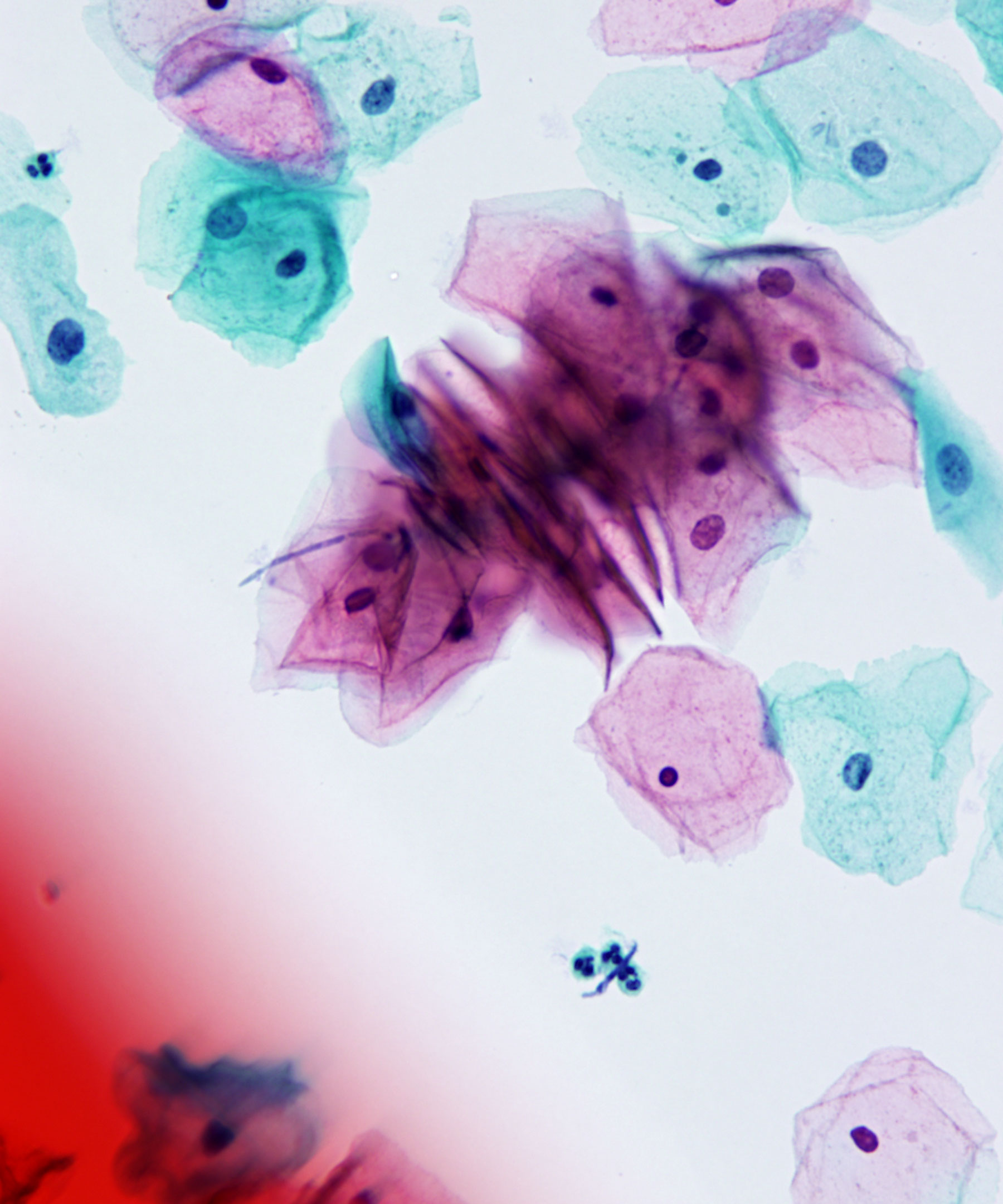 02 : Gynecologic Cytology Candida