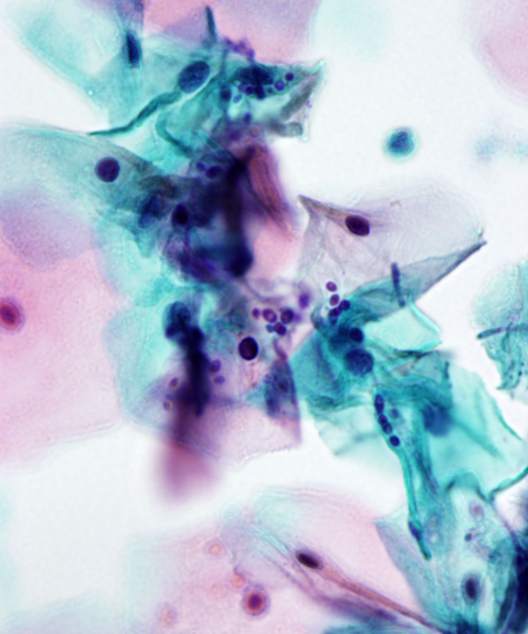03 : Gynecologic Cytology Candida