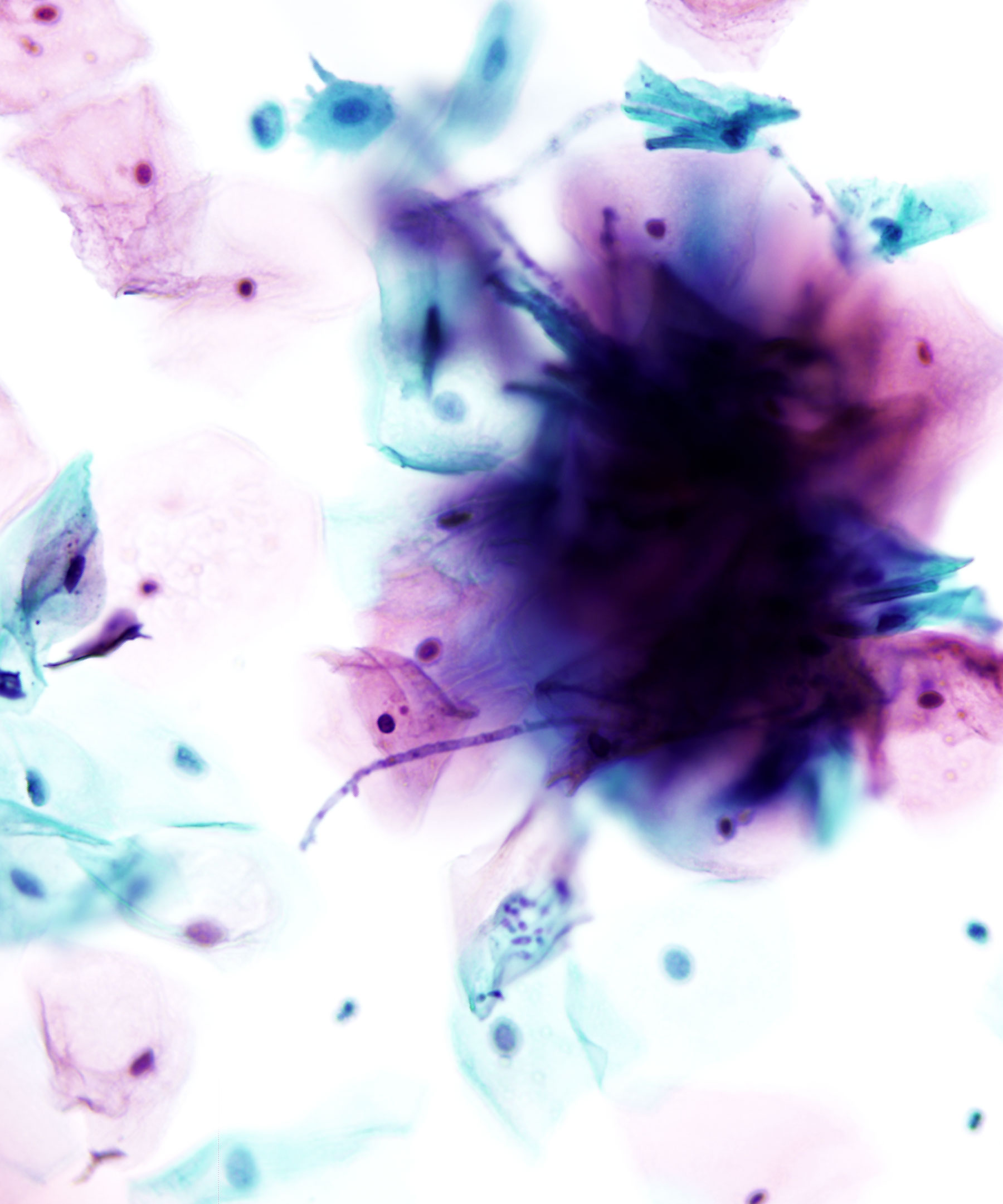 04 : Gynecologic Cytology Candida
