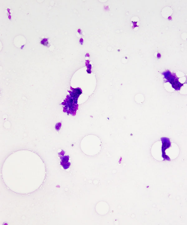 image showing 'Giant Cell Tumor of Tendon Sheath'