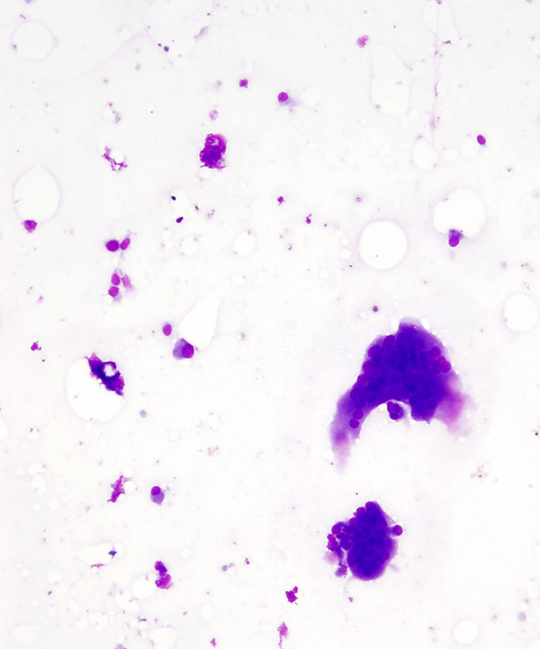 02 : Giant Cell Tumor of Tendon Sheath