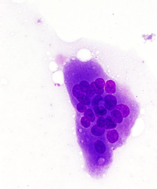 03 : Giant Cell Tumor of Tendon Sheath