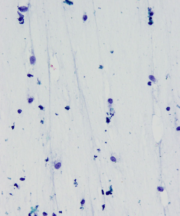 04 : Giant Cell Tumor of Tendon Sheath