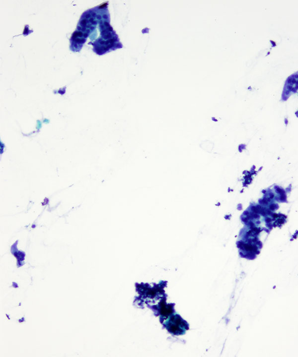 05 : Giant Cell Tumor of Tendon Sheath