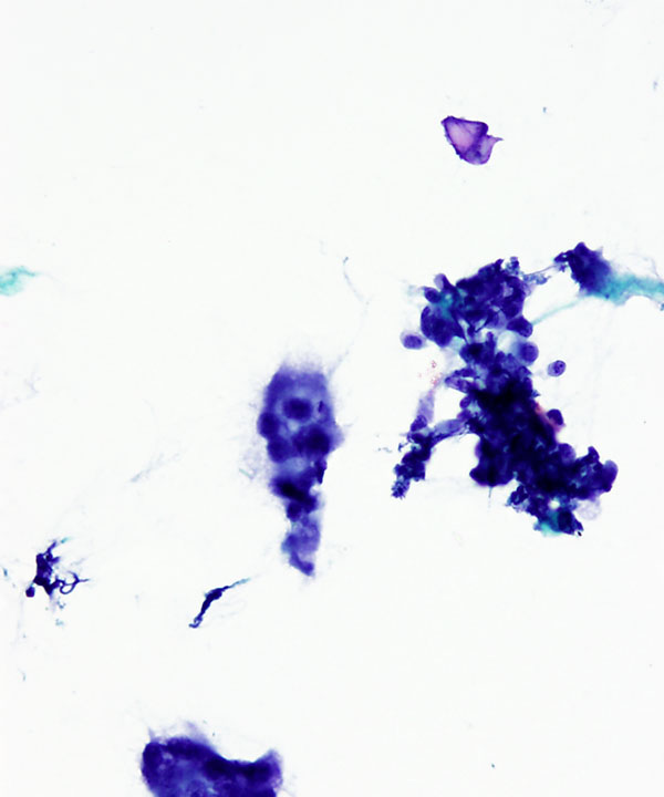 06 : Giant Cell Tumor of Tendon Sheath