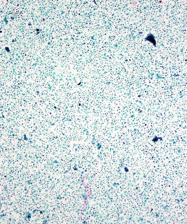 image showing 'Atrophy'