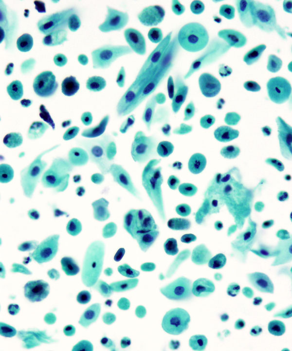 02 : Gynecologic Cytology Atrophy