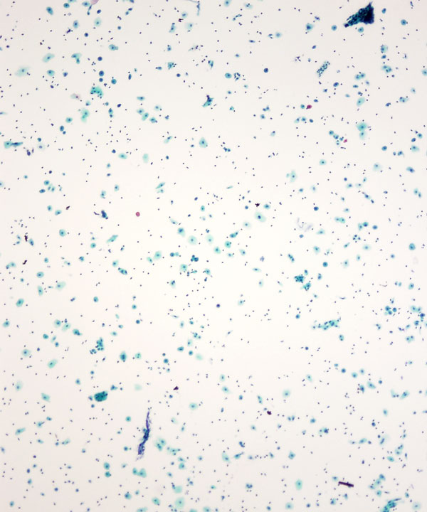 03 : Gynecologic Cytology Atrophy