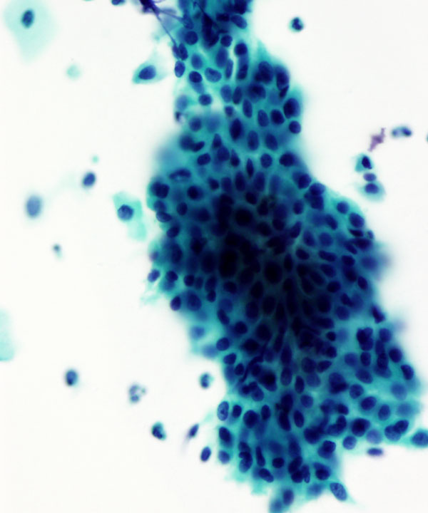 04 : Gynecologic Cytology Atrophy