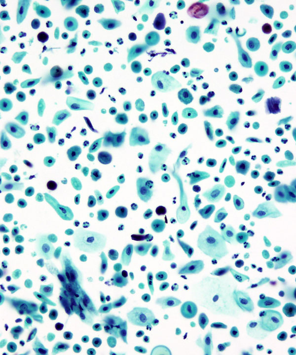 05 : Gynecologic Cytology Atrophy