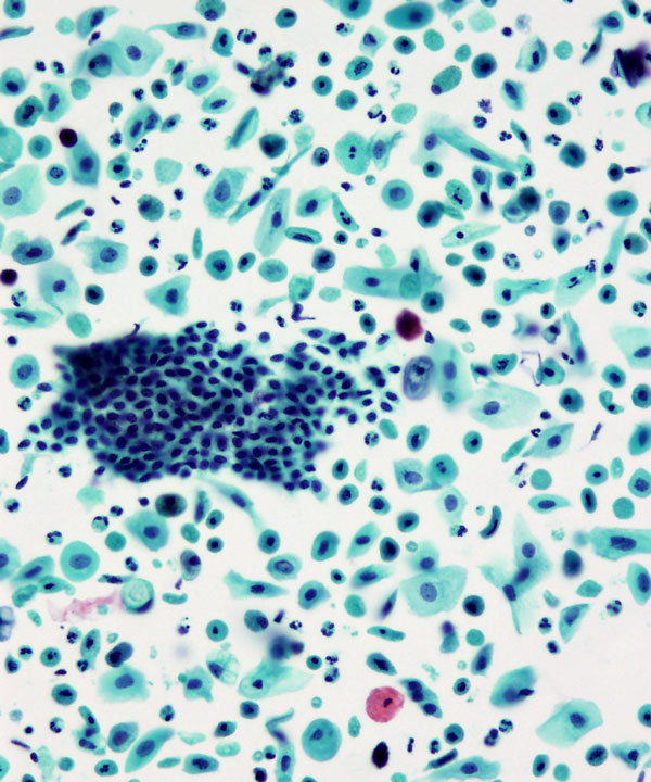 06 : Gynecologic Cytology Atrophy