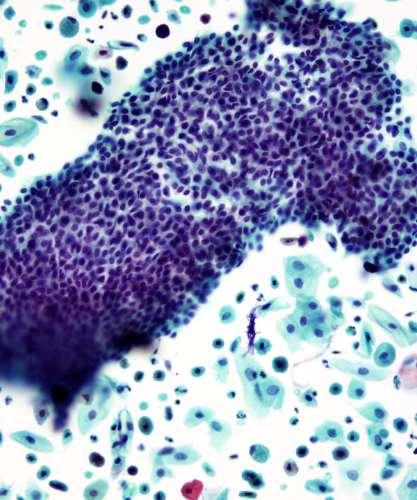 07 : Gynecologic Cytology Atrophy