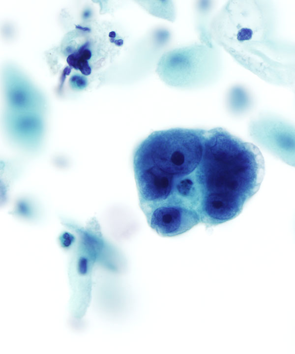 image showing 'Endocervical Adenocarcinoma'