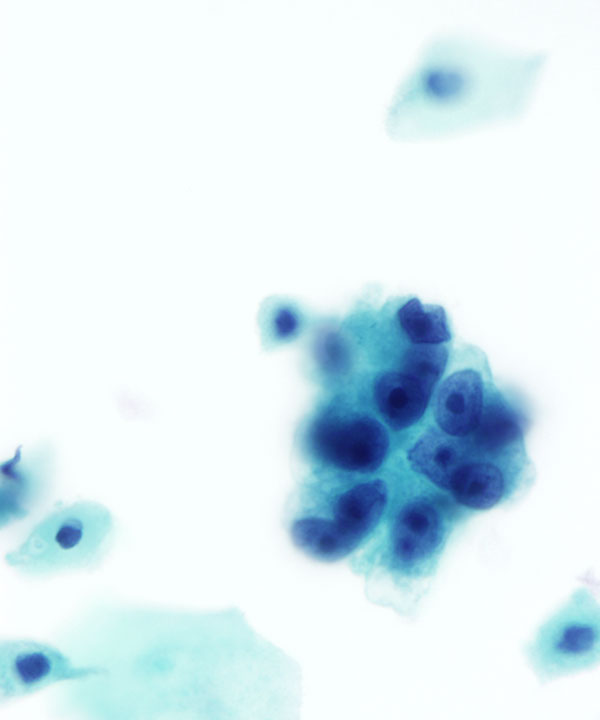 02 : GynEndocervical Adenocarcinoma