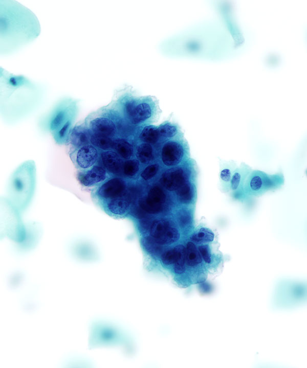 03 : GynEndocervical Adenocarcinoma