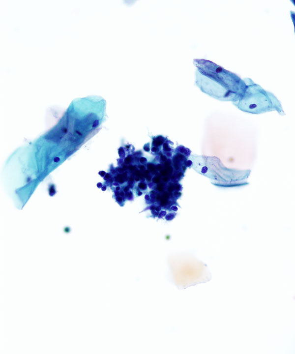 image showing 'Follicular Cervicitis'