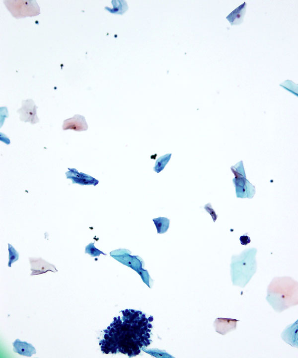 03 : Gynecologic Cytology Follicular Cervicitis