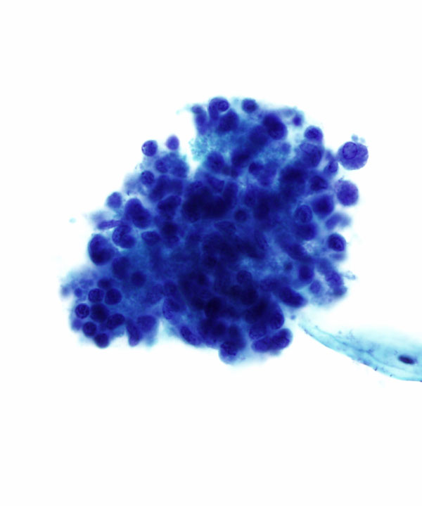 04 : Gynecologic Cytology Follicular Cervicitis